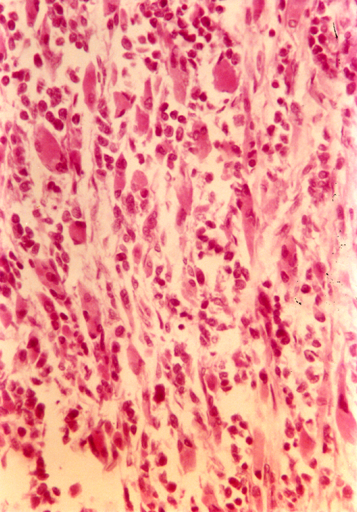 oralpat_rhabdomyosarcoma2.jpg